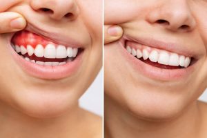 patient shows gum before and after periodontal treatment