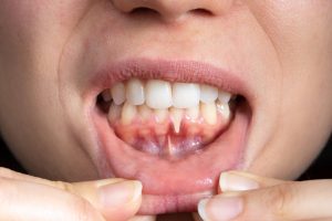 patient with gum disease shows signs of gum recession