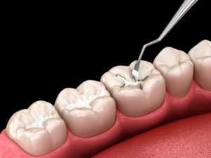 composite dental fillings